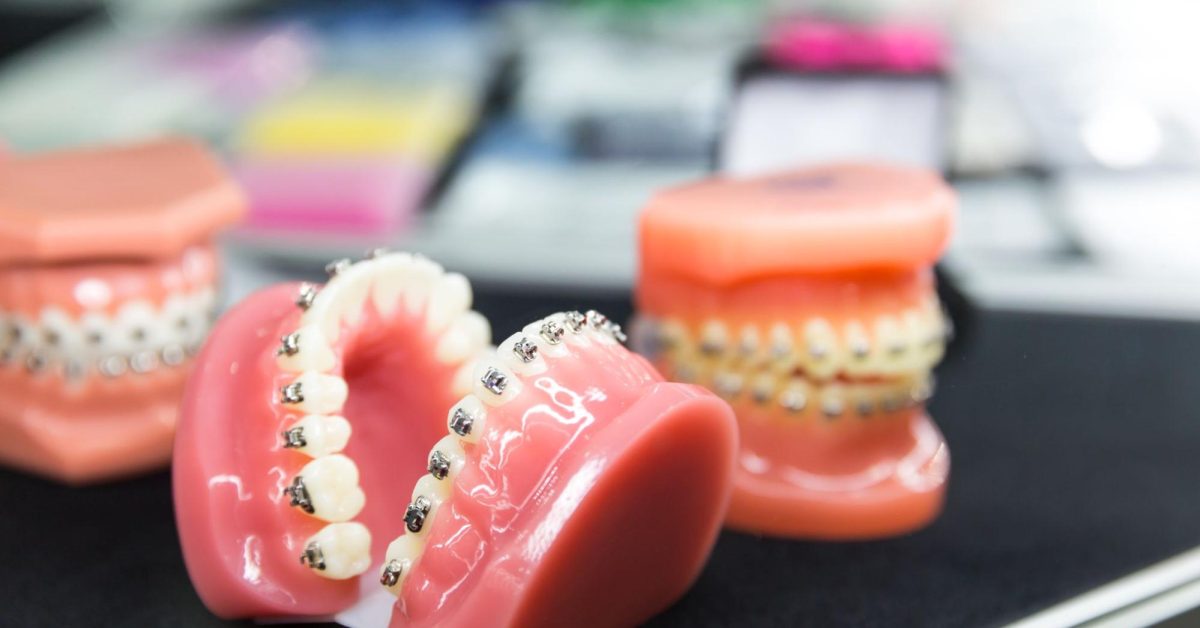 Breaking Down the Cost of Orthodontics