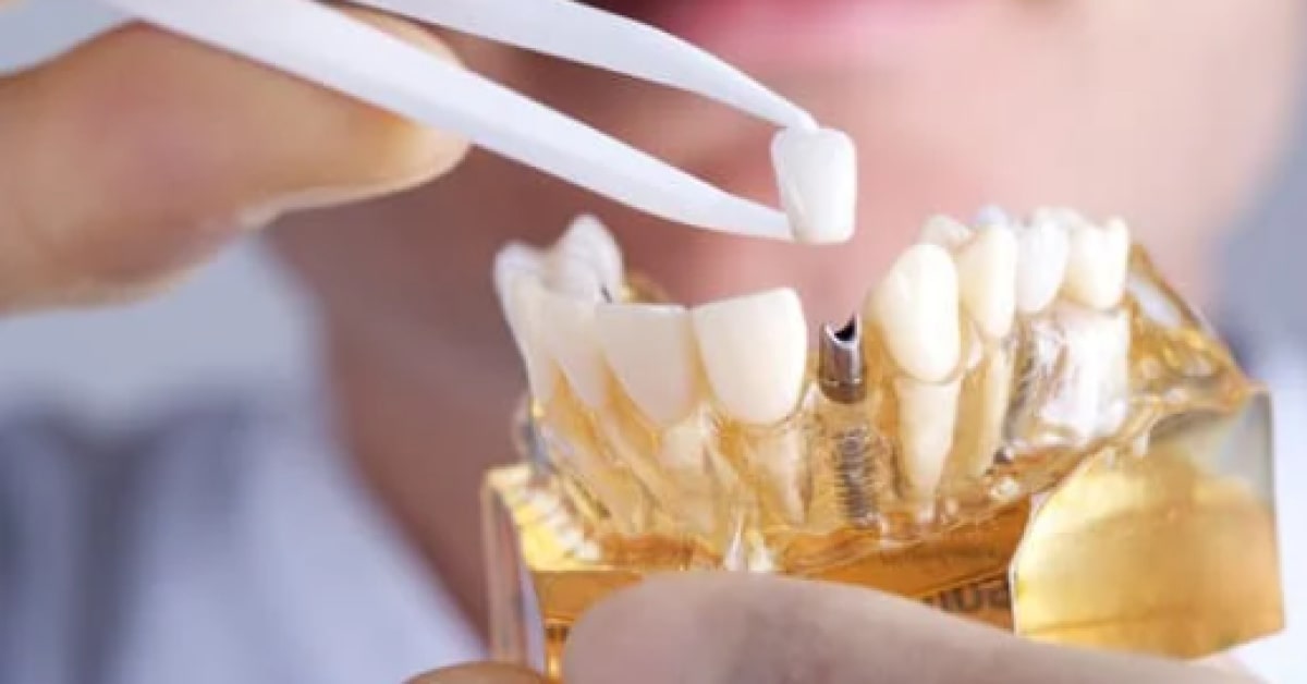 Demystifying Dental Implant Coverage