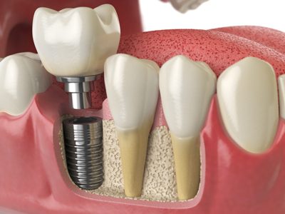 Taking the Mystery Out of Billing Medical For Dental Implants